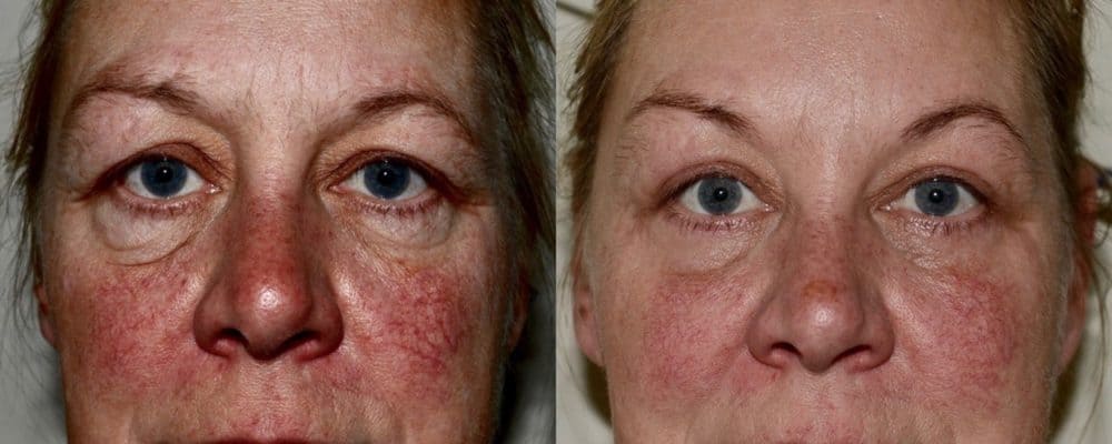 Upper and lower eyelid blepharoplasty