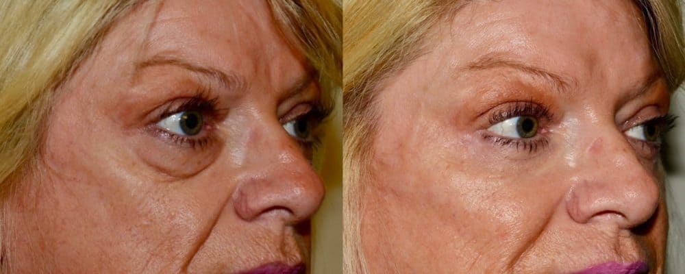 Lower eyelid surgery and fat transfer