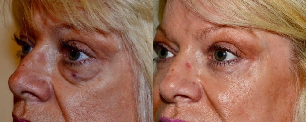 Lower eyelid surgery and fat transfer