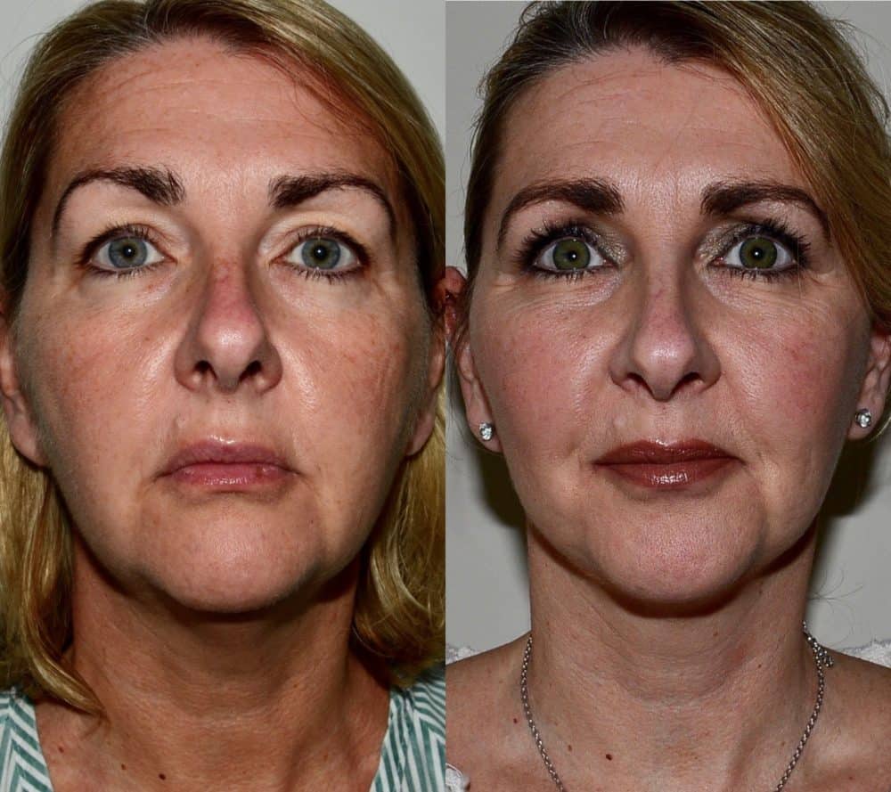 Facelift before and after and fat transfer