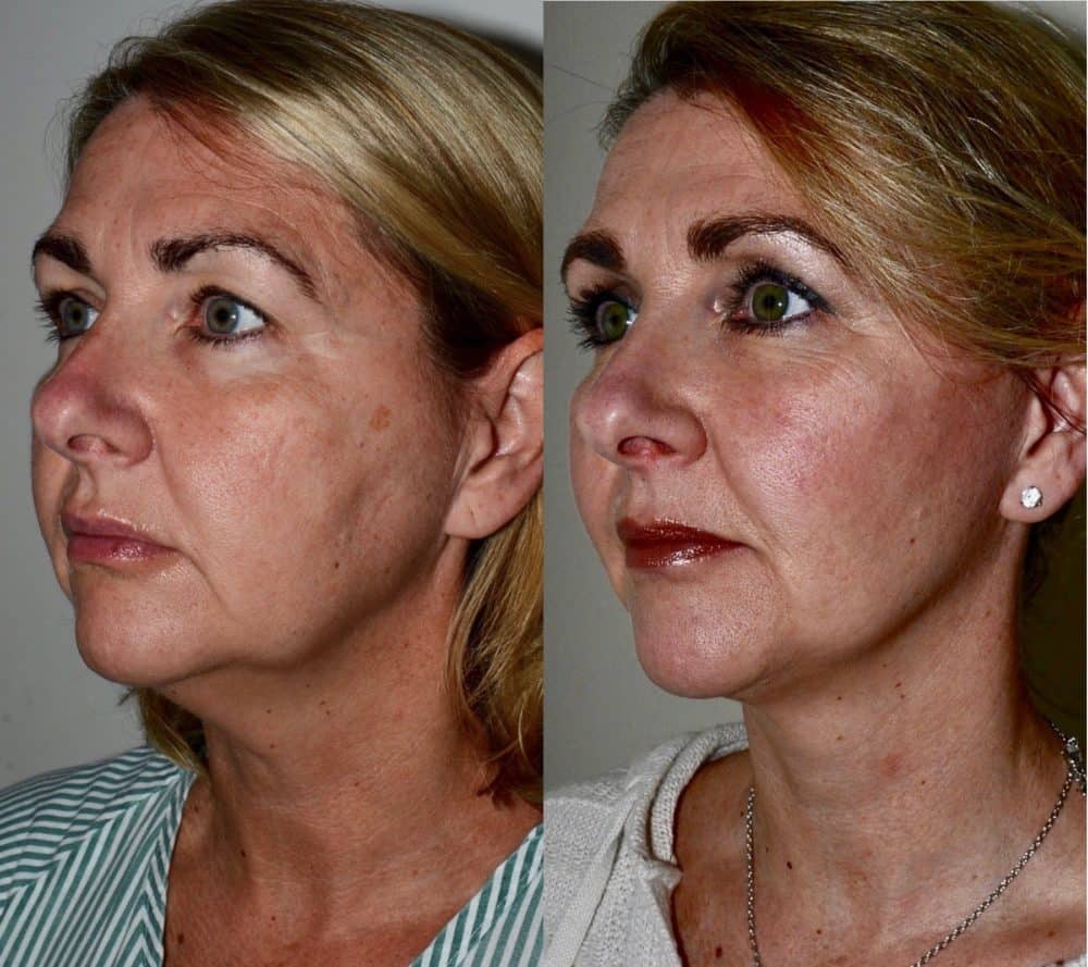 Facelift before and after and fat transfer