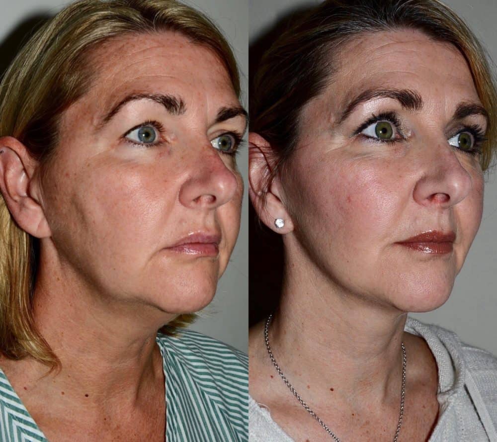 Facelift before and after and fat transfer