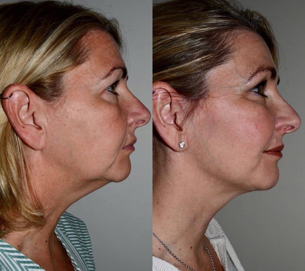 facelift before and after