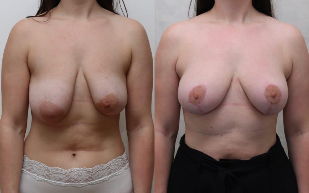 breast uplift edinburgh