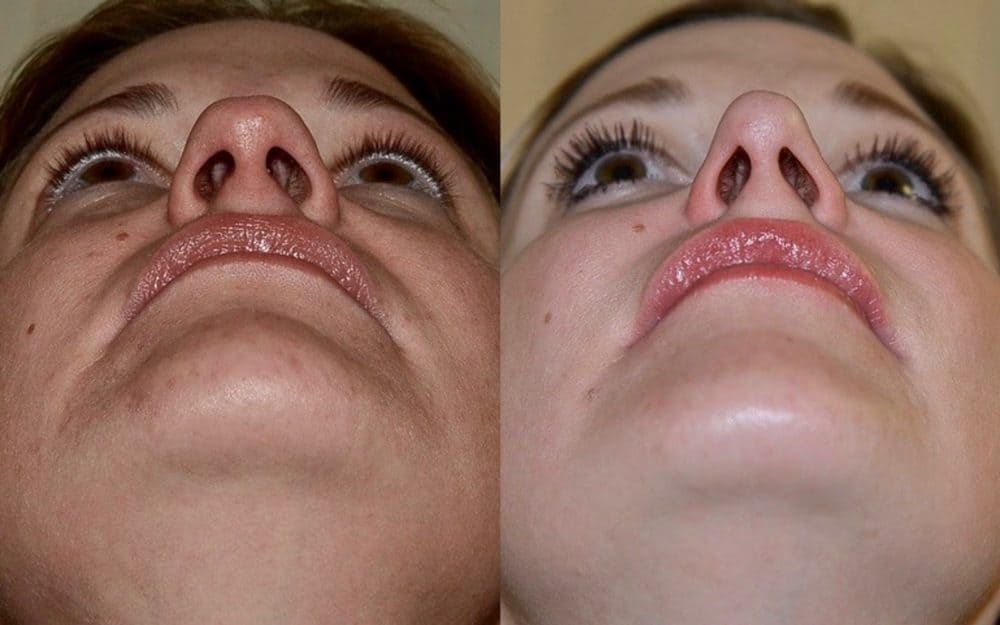 Nasal tip refinement