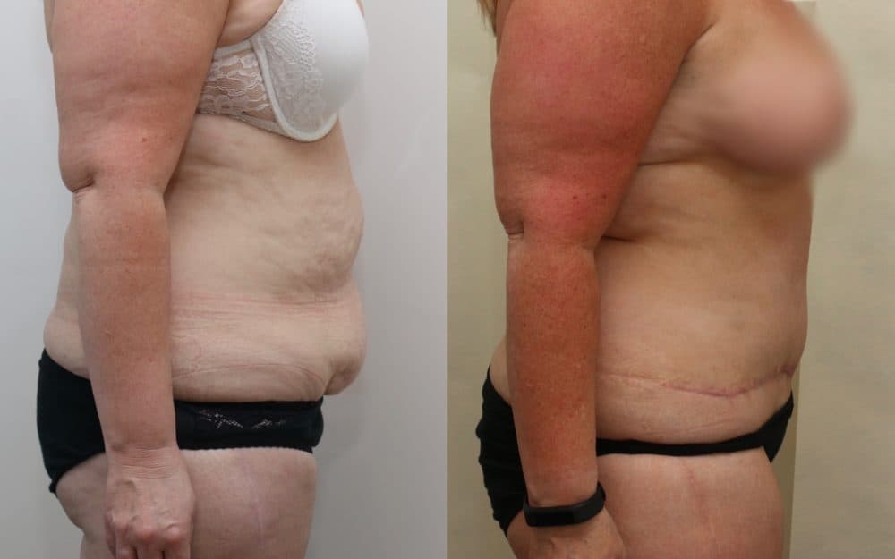 Full Tummy Tuck
