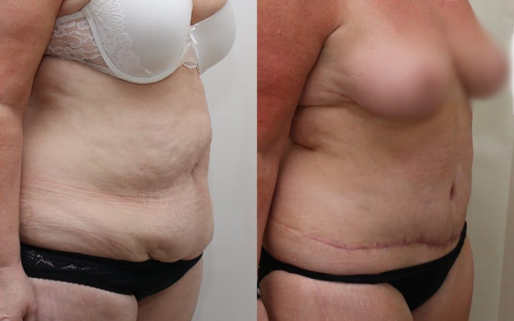 Full Tummy Tuck