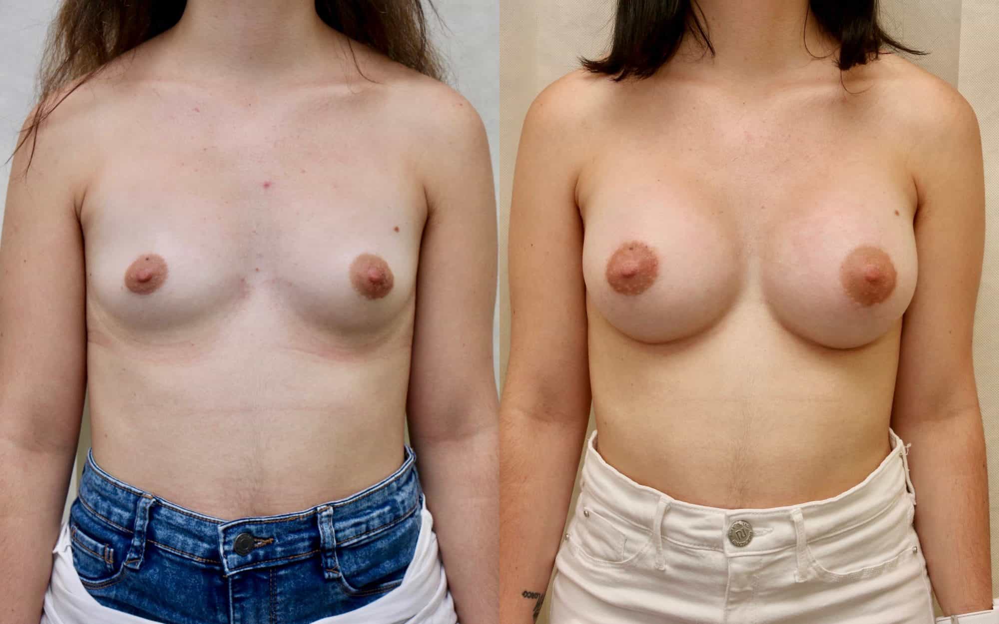 breast augmentation before and after uk