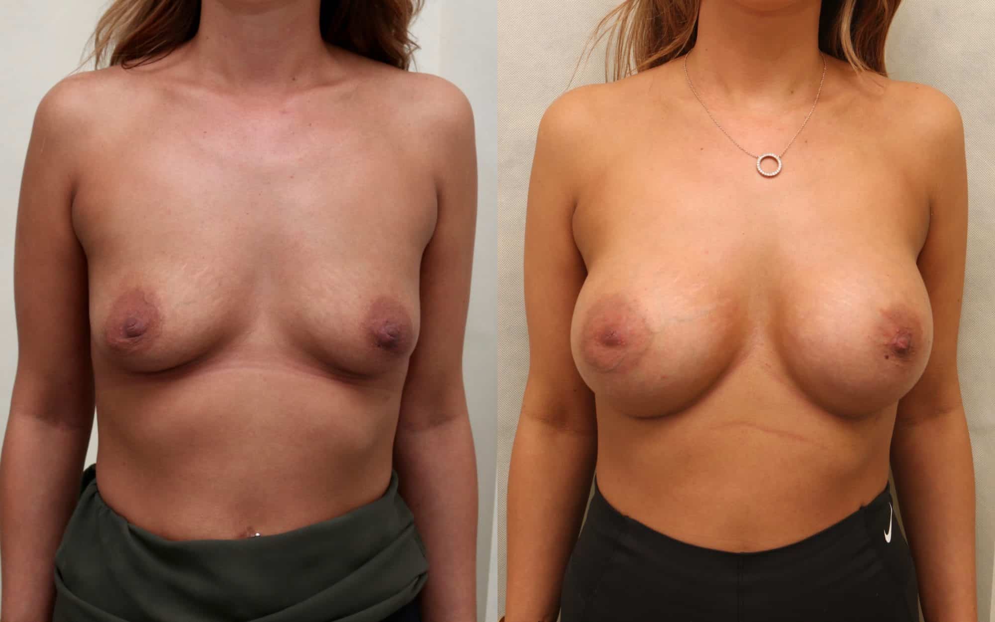 breast implants edinburgh