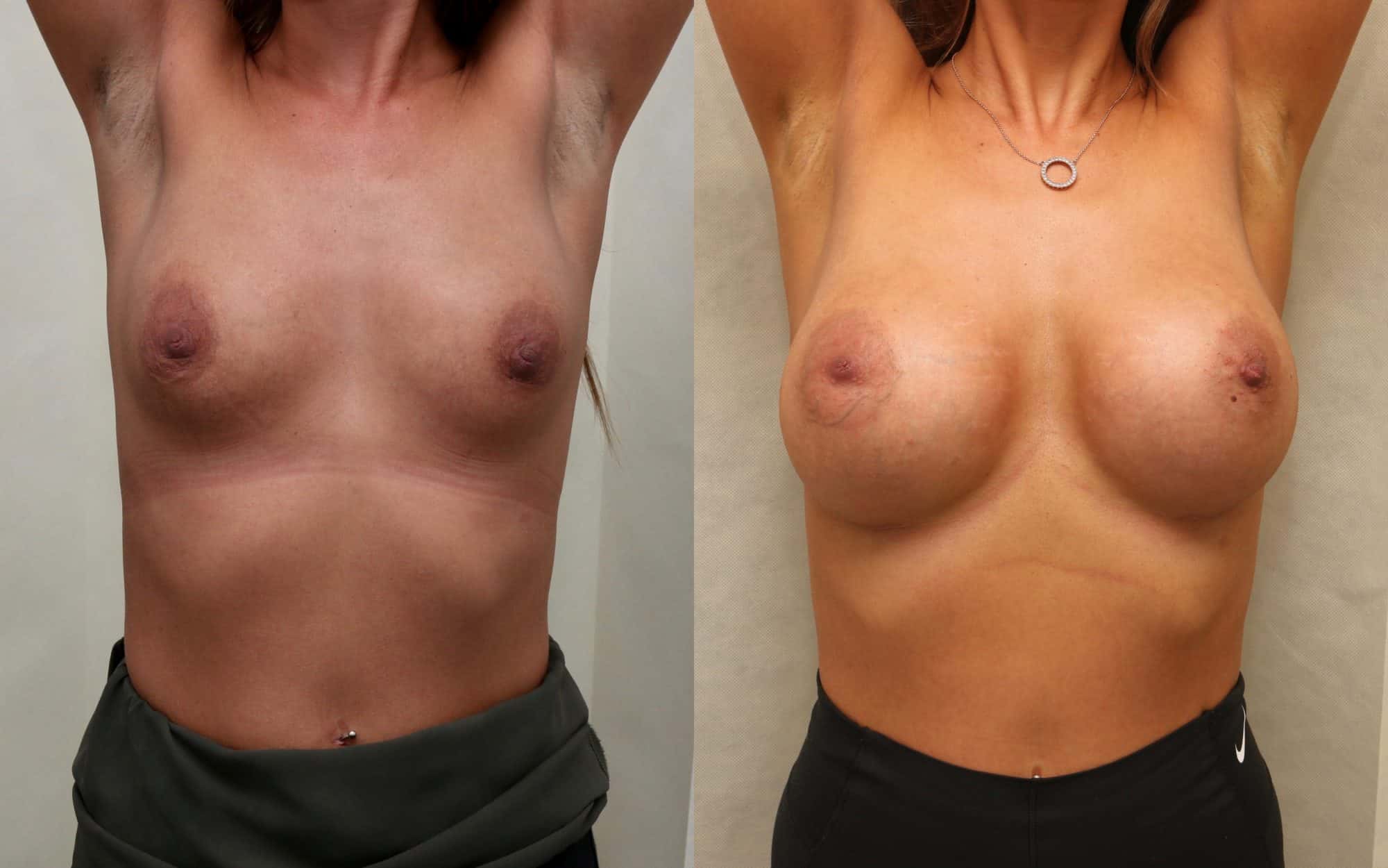 B to E/F cup breast augmentation