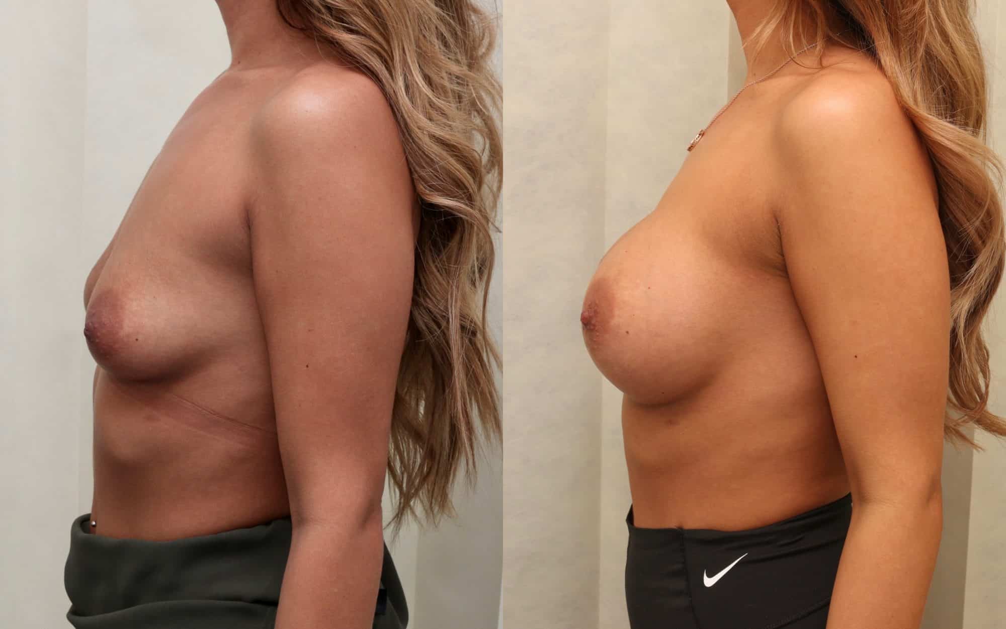 B to E/F cup breast augmentation