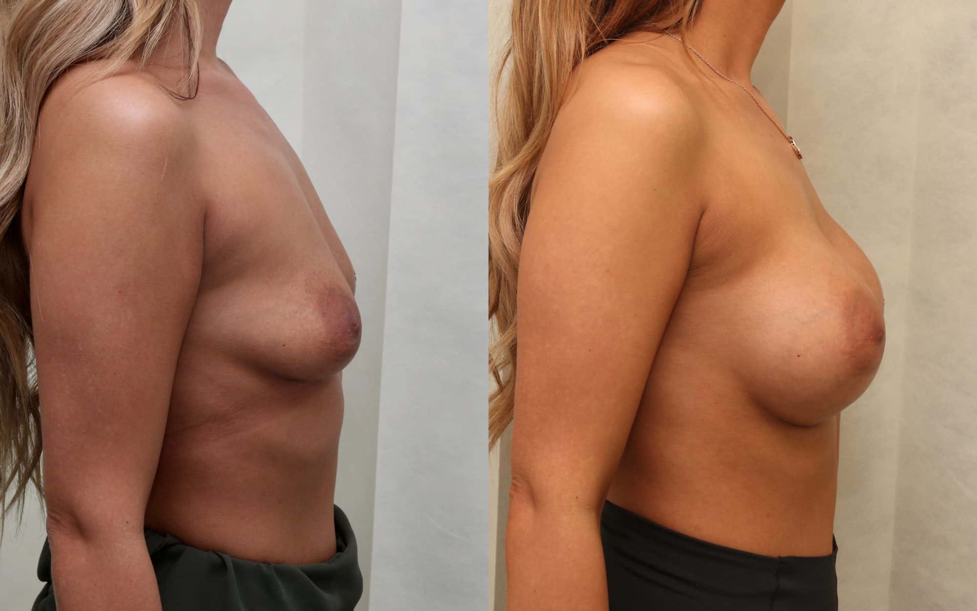 B to E/F cup breast augmentation