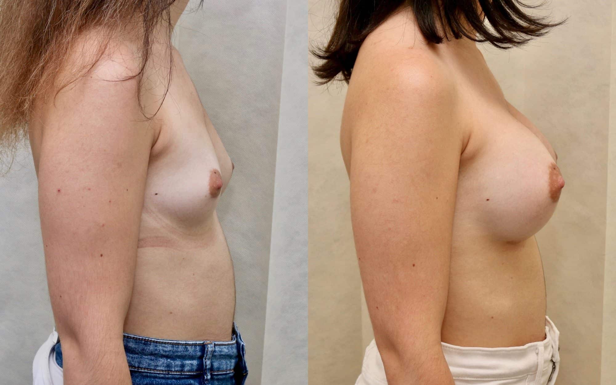 breast implants before and after uk