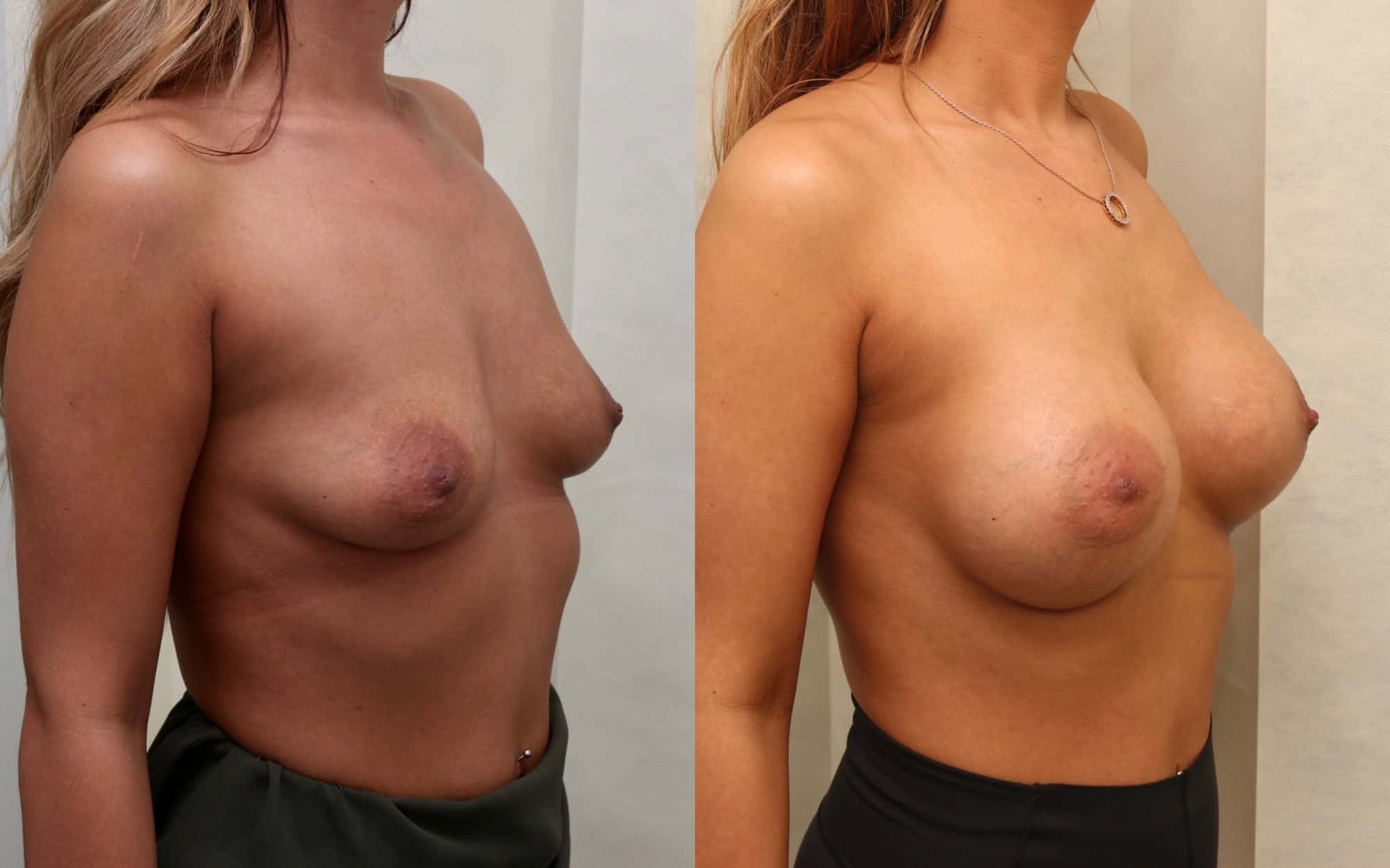 B to E/F cup breast augmentation