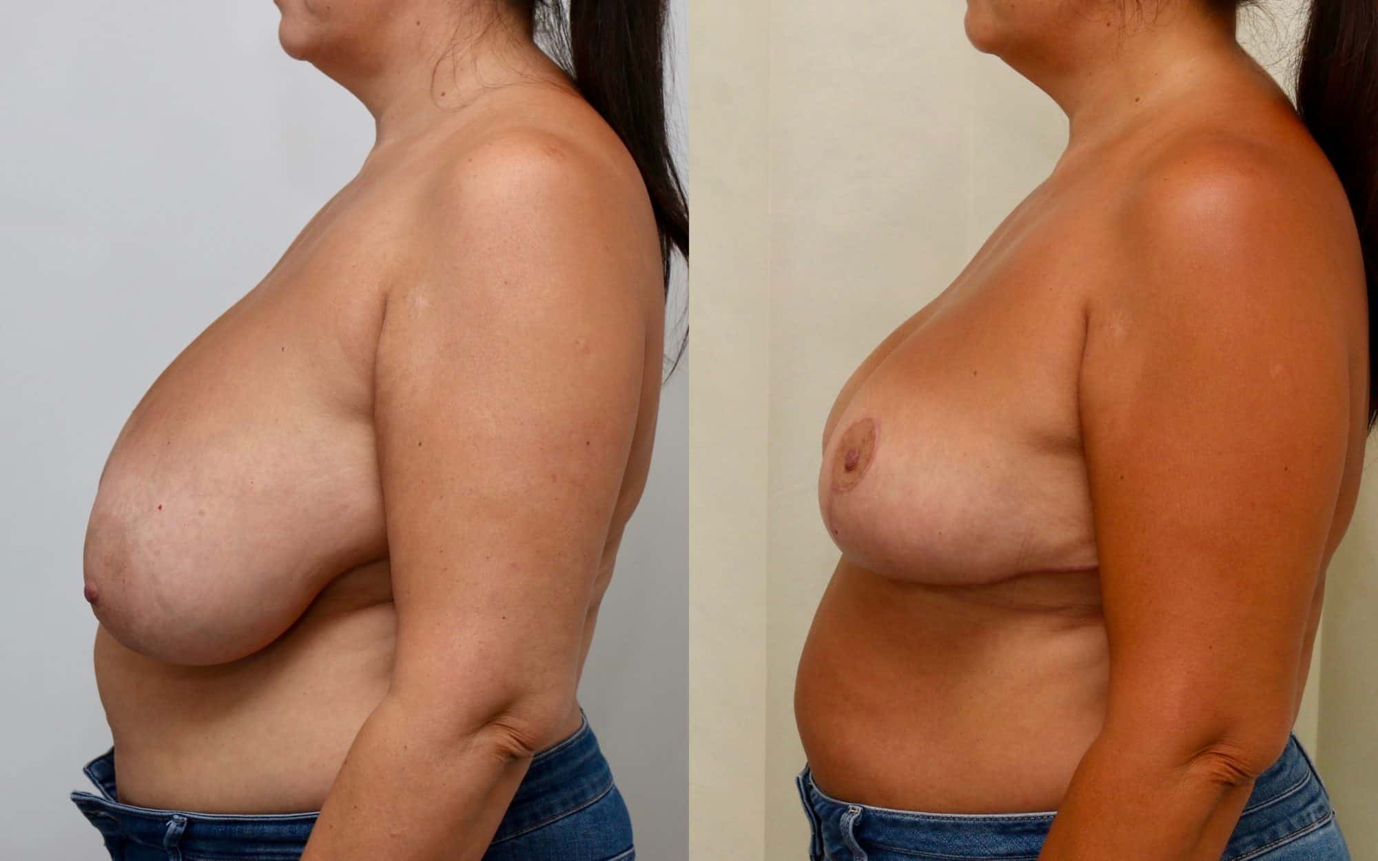Moderate breast reduction before and after