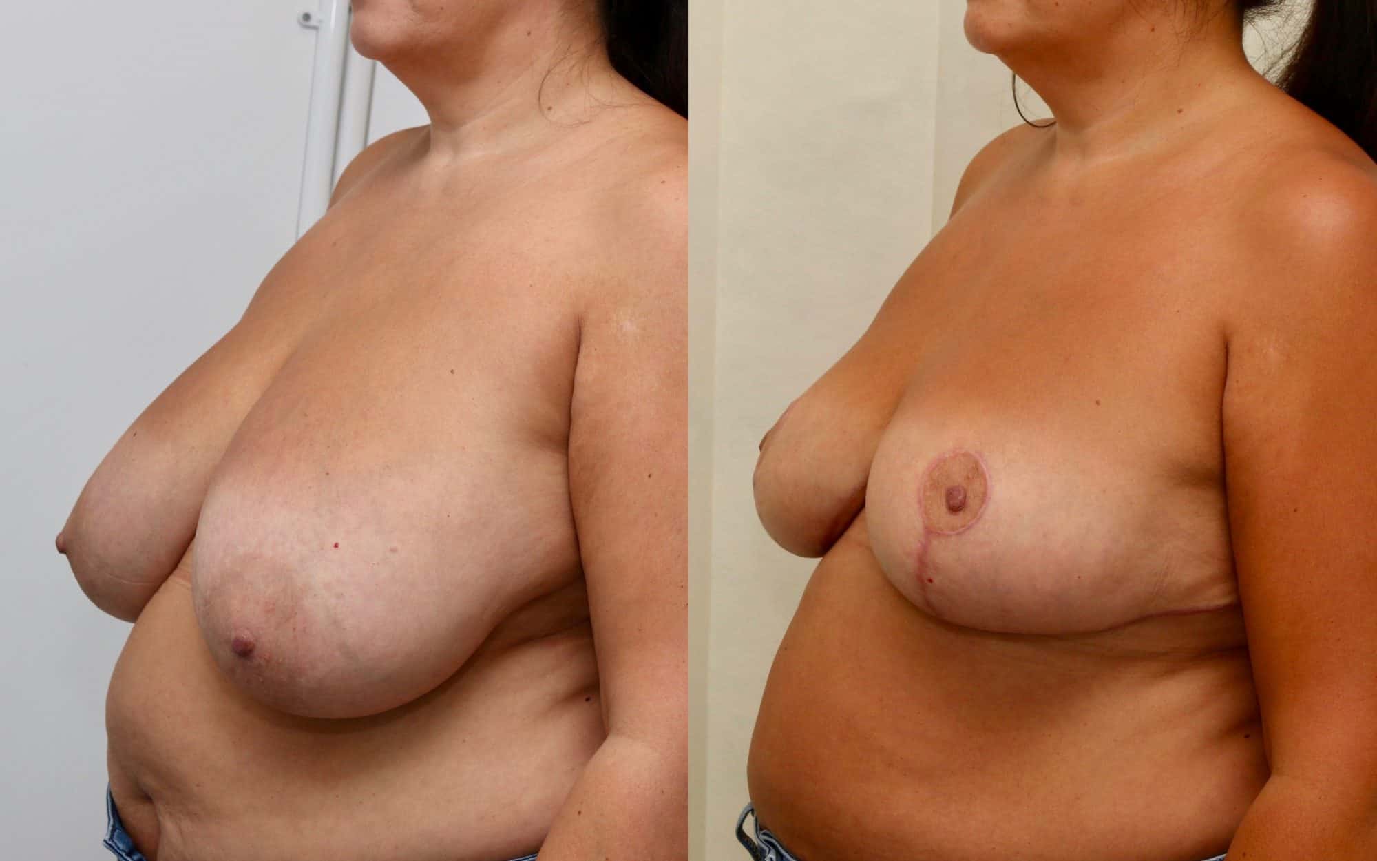 Moderate breast reduction before and after