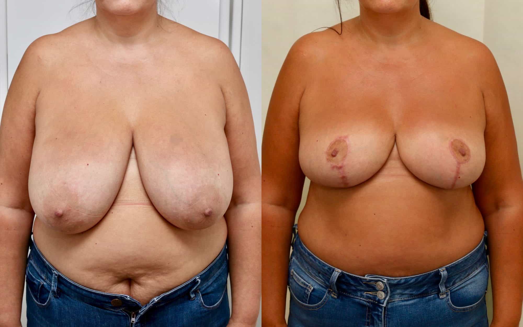 Moderate breast reduction before and after