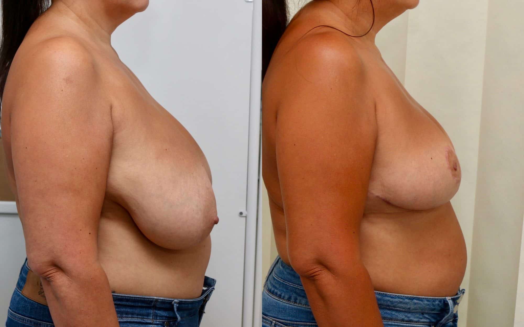 Moderate breast reduction before and after