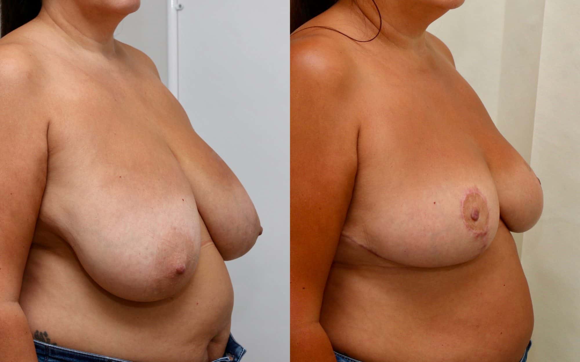 Moderate breast reduction before and after