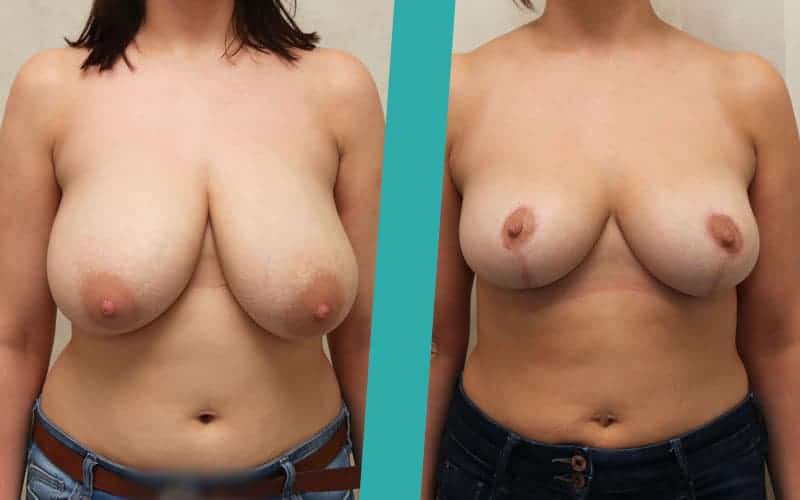 breast-reduction1