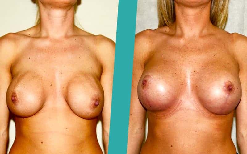 breast-revision23