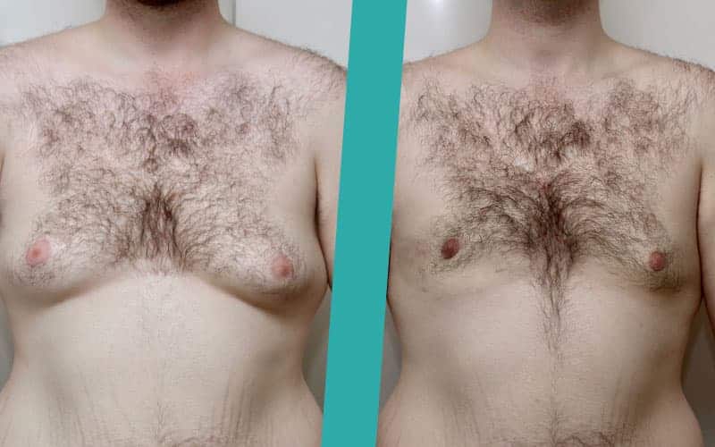 Male Breast reduction before and after photo
