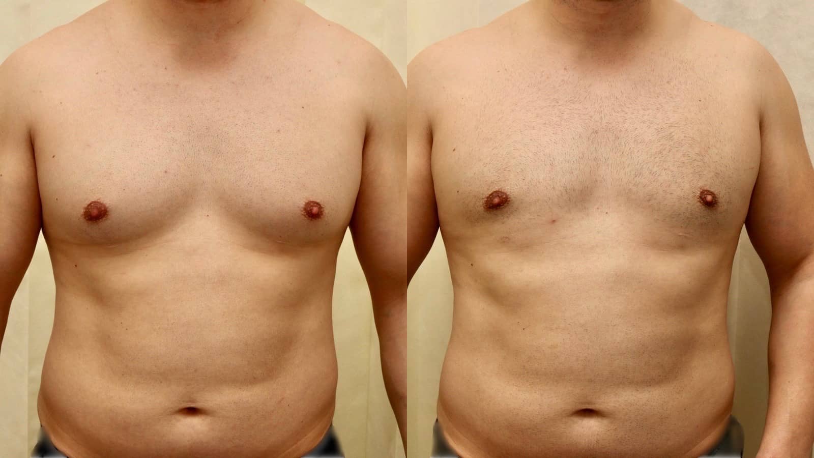 moob surgery before and after