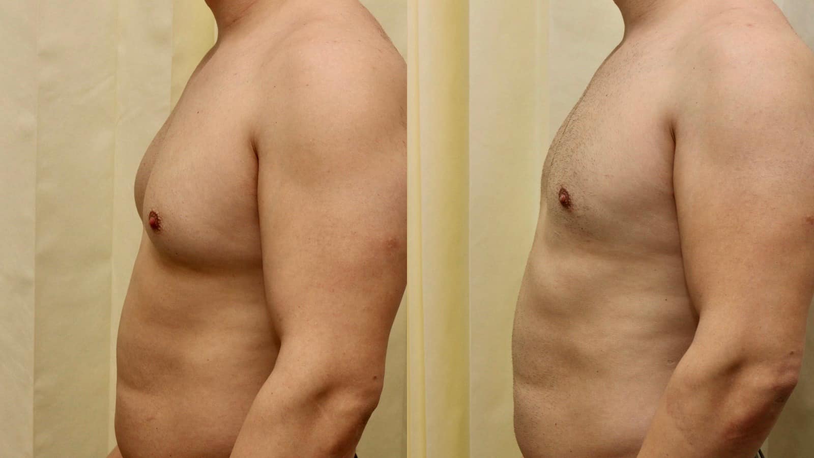 moob surgery before and after
