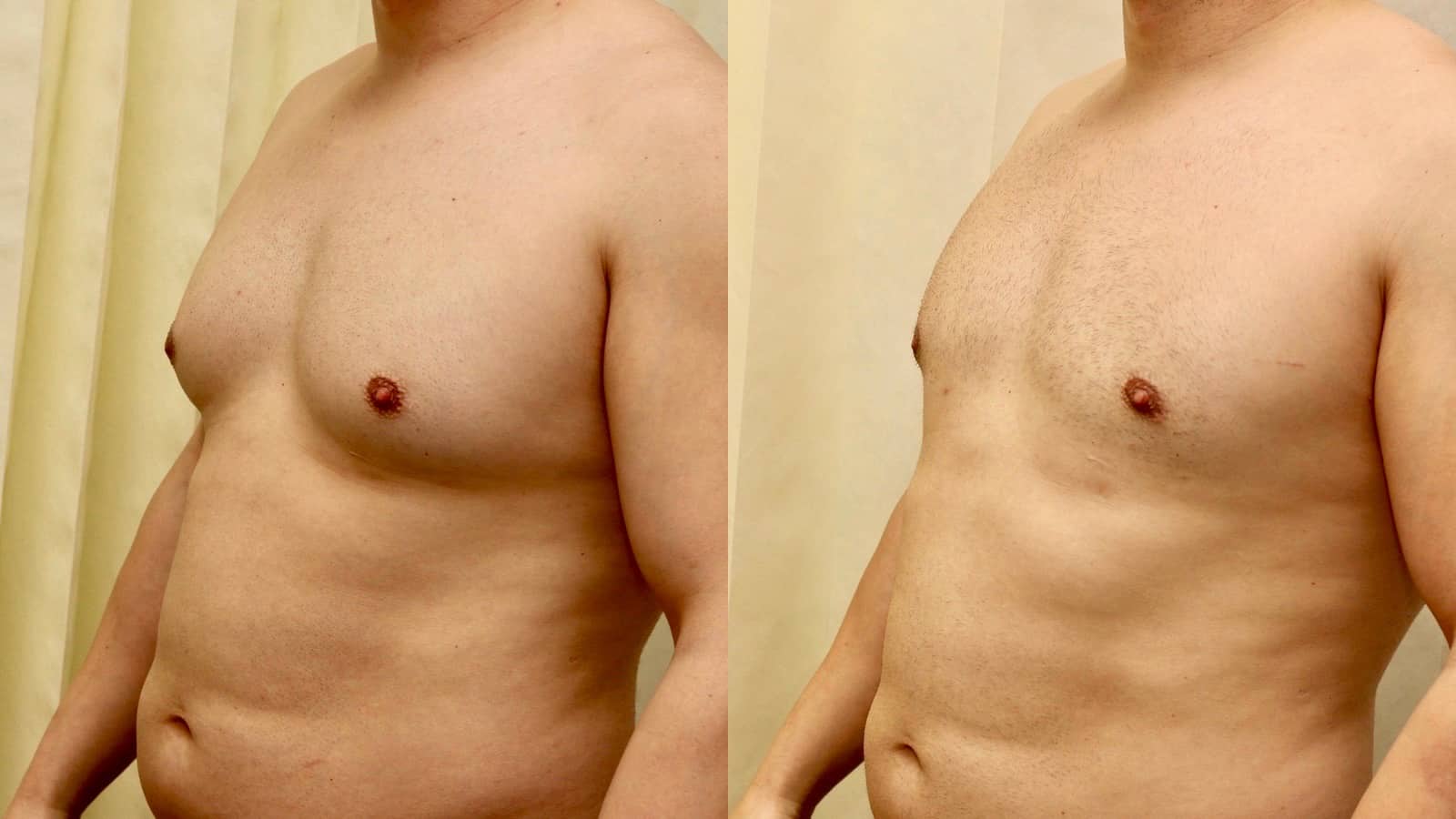 moob surgery before and after