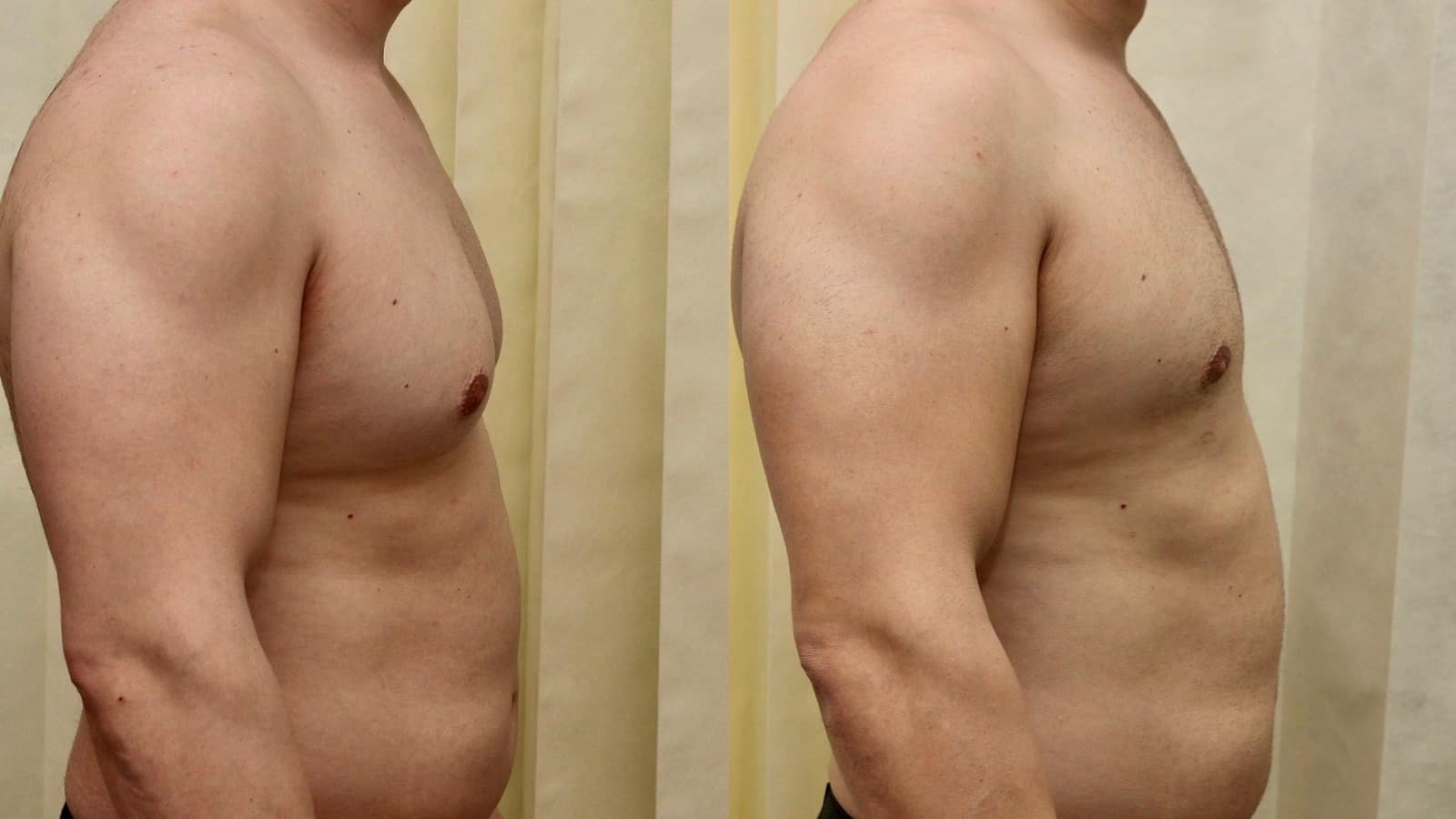 moob surgery before and after