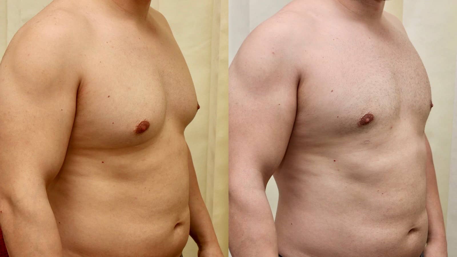 moob surgery before and after