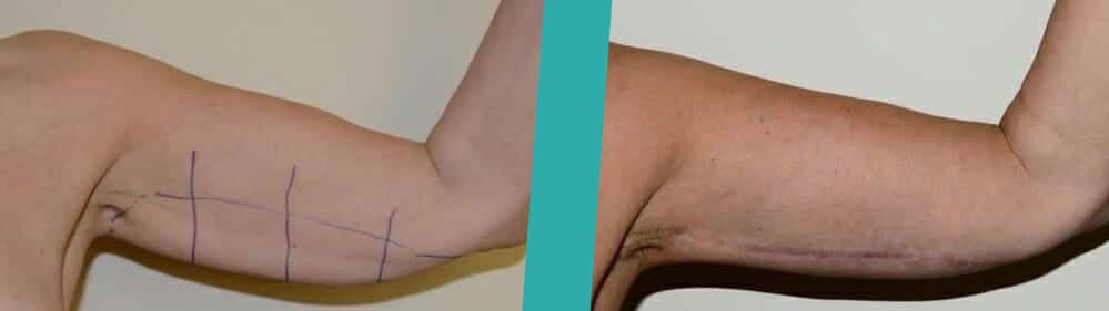 armreduction2 arm reduction Scotland