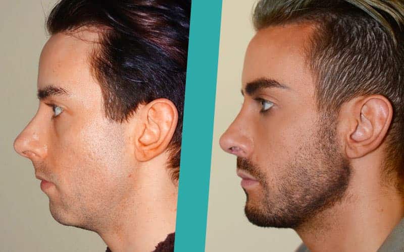 chin-surgery-before-after-photos1 chin implants scotland