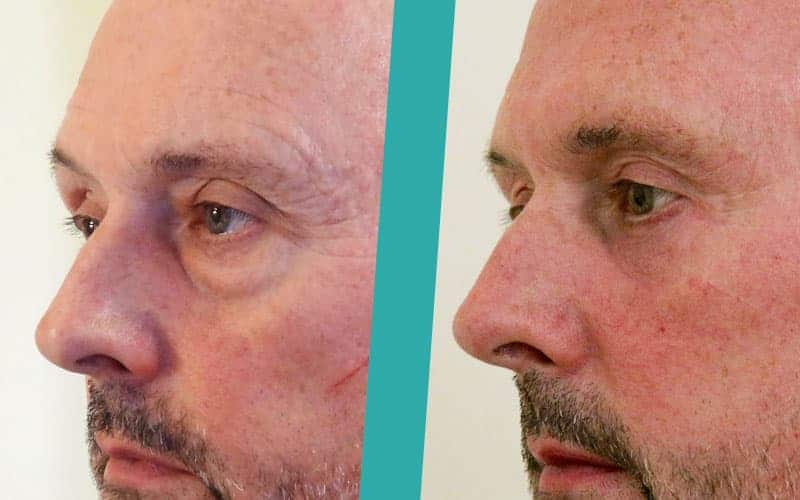 eye-lid-surgery-before-after-photos1 eyelid surgery scotland