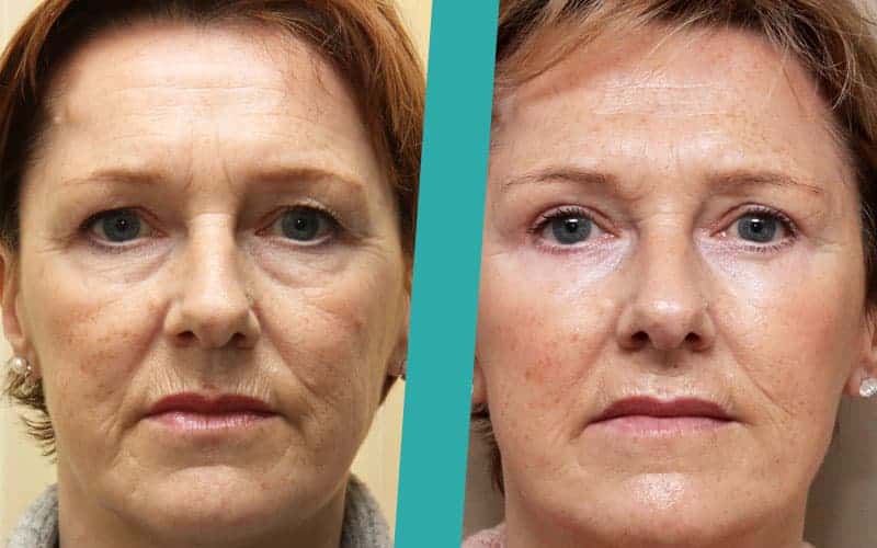 eye-lid-surgery-before-after-photos2 eyelid surgery before and after