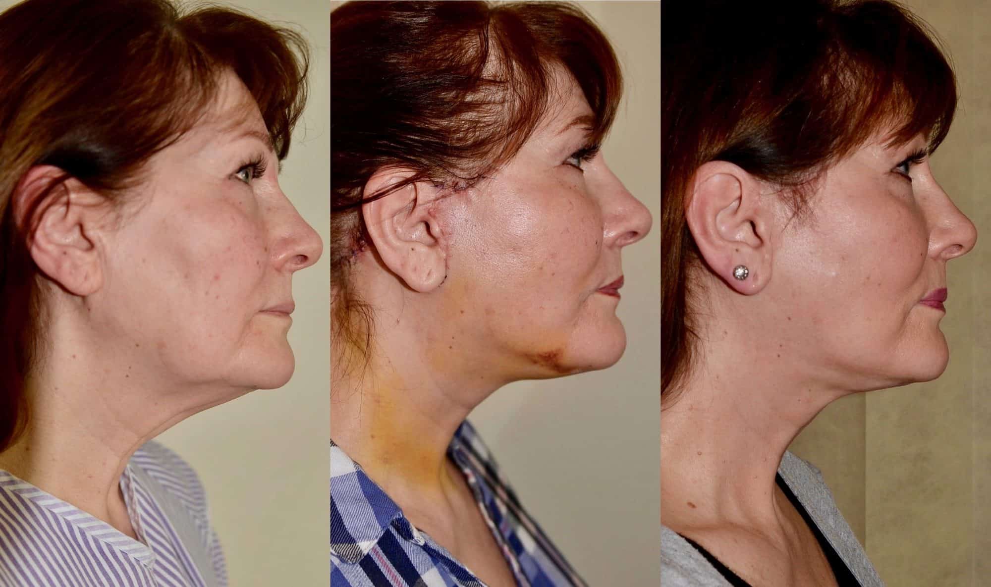 neck lift before and after