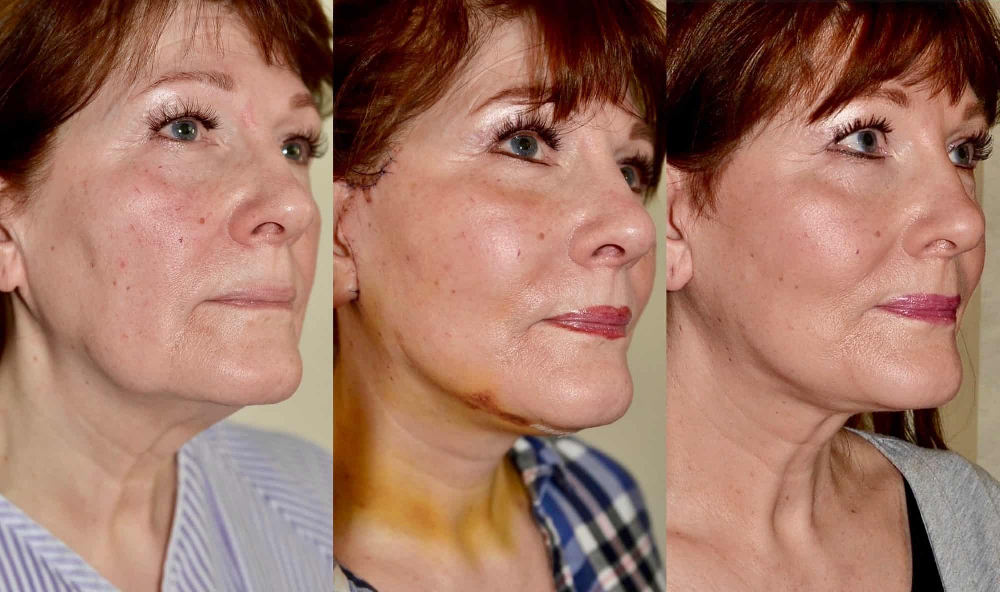 facelift surgery scotland