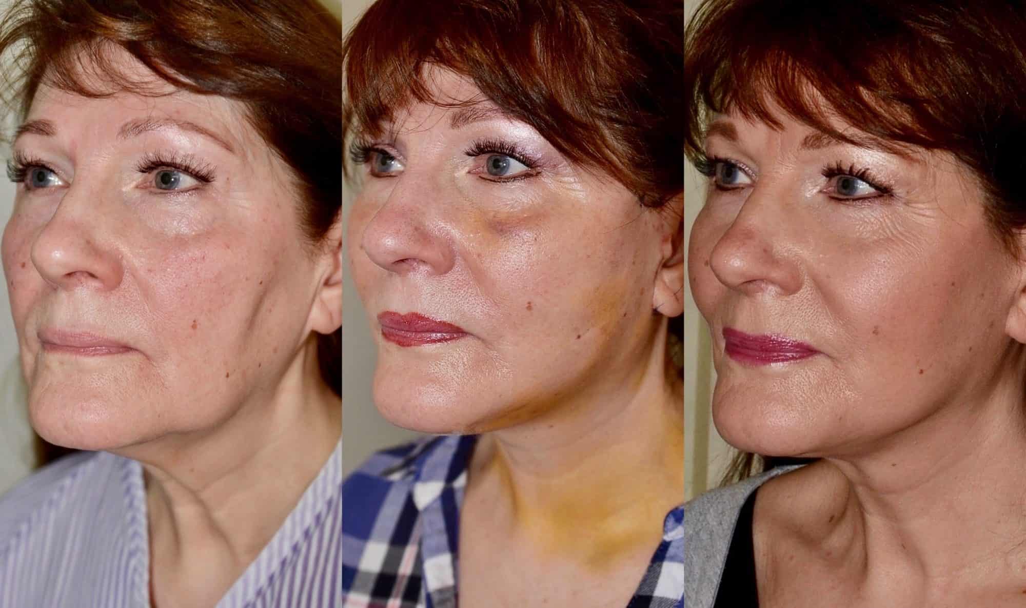 facelift before and after uk