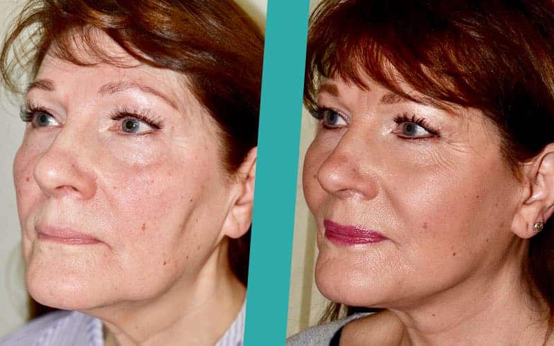 facelift-surgery-before-after-photos2 neck lift edinburgh