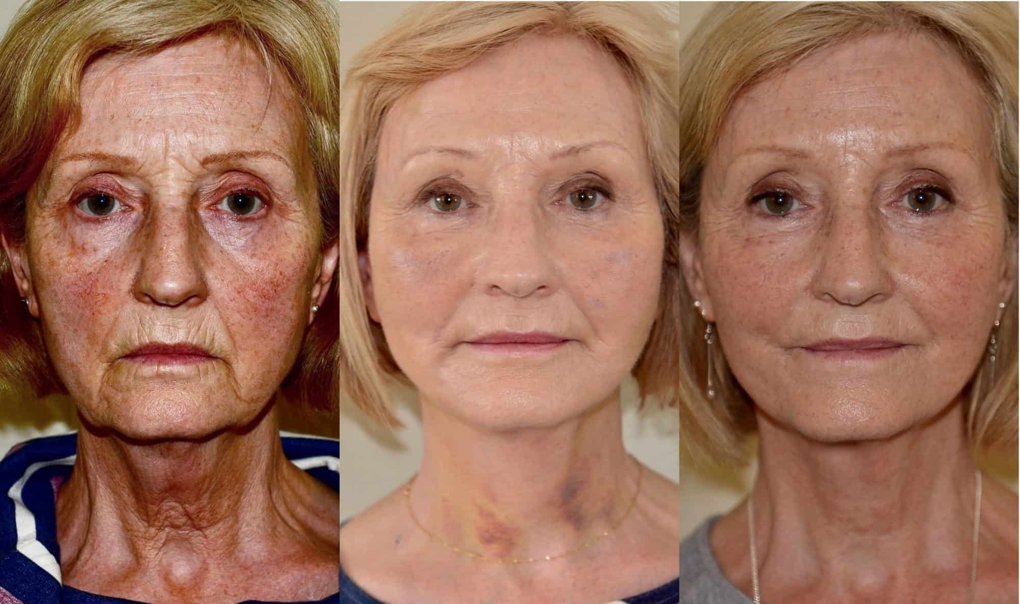 facelift before and after uk