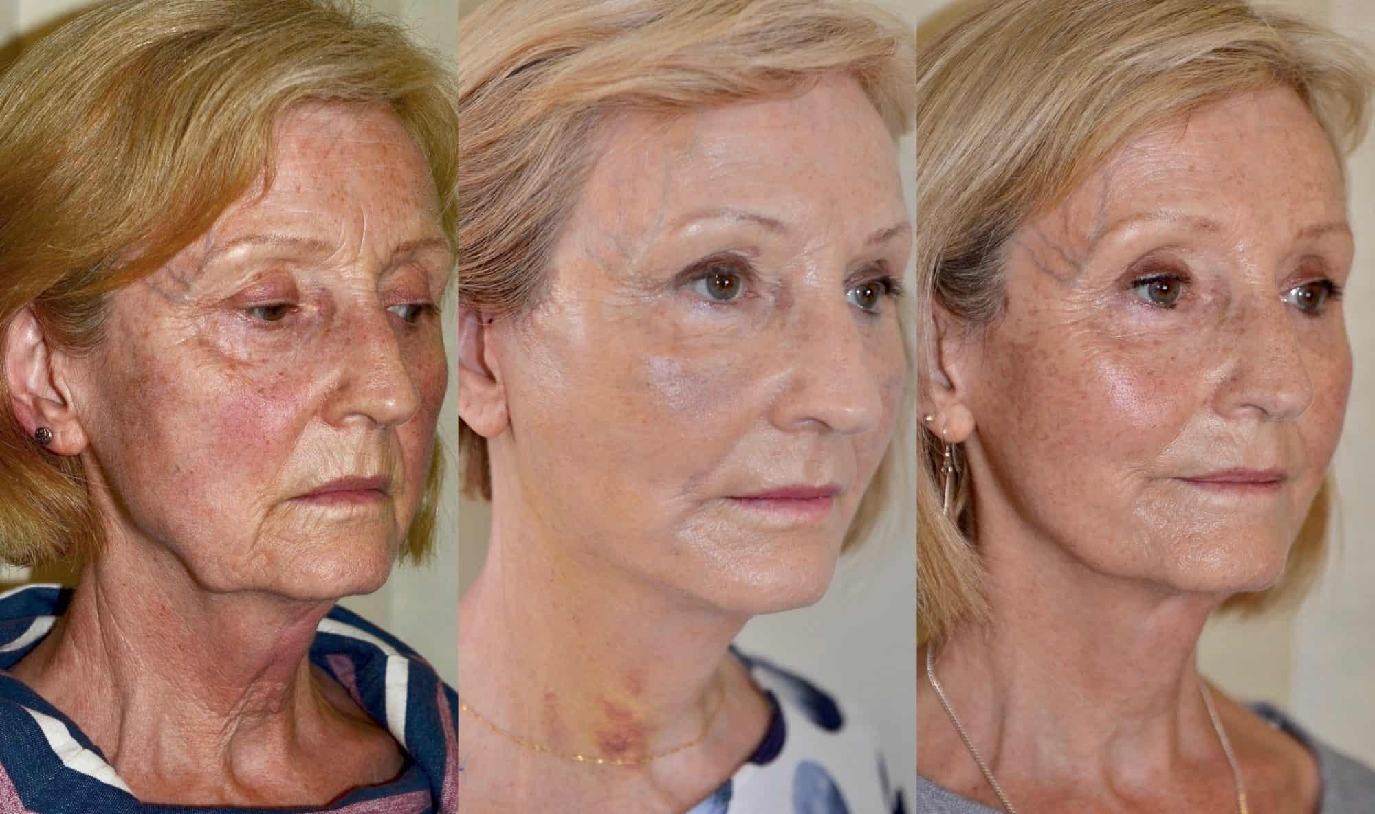 facelift before and after photos