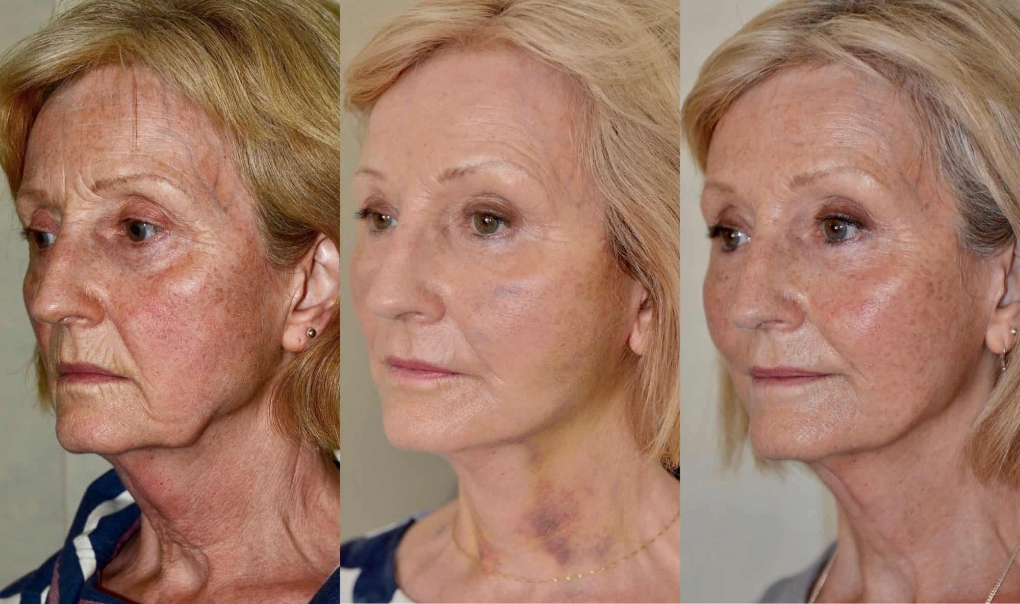 facelift before and after scotland