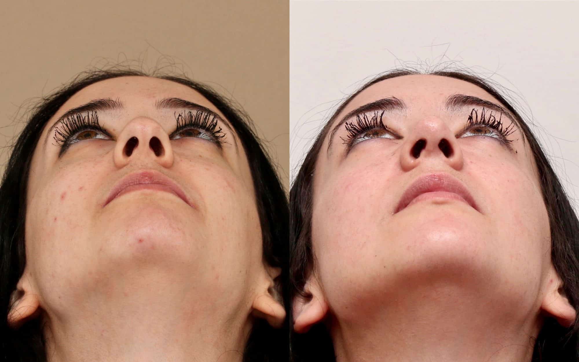 nose job before and after