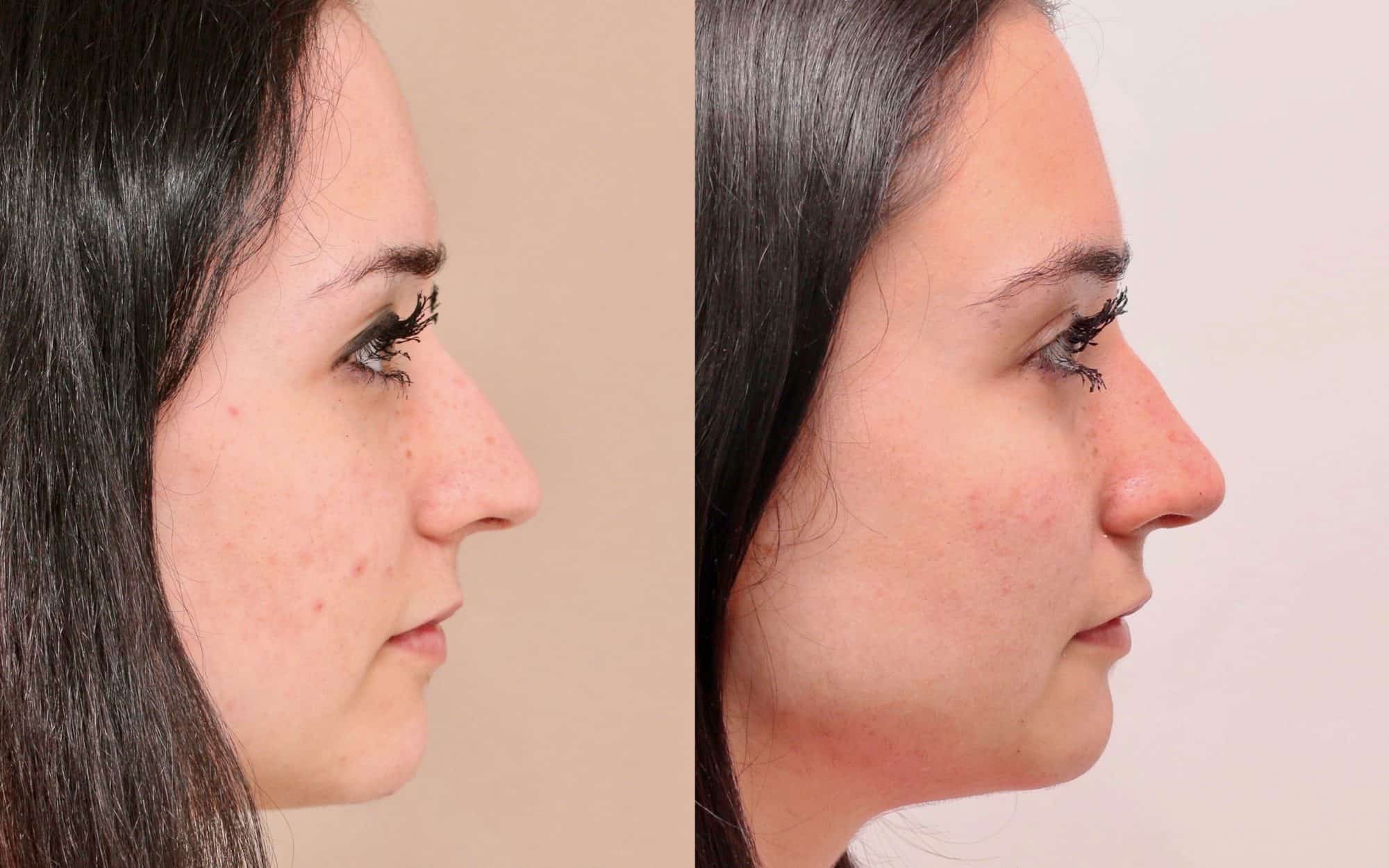 nose job before and after