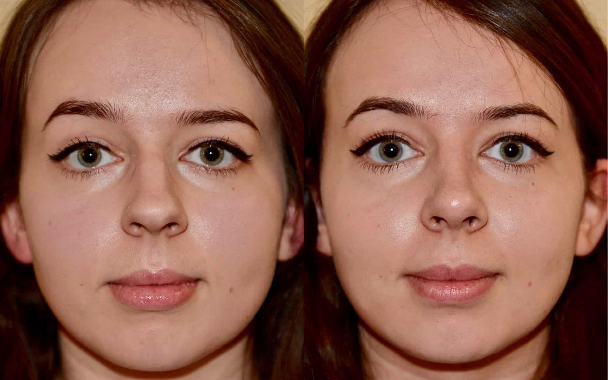 nose job before and after