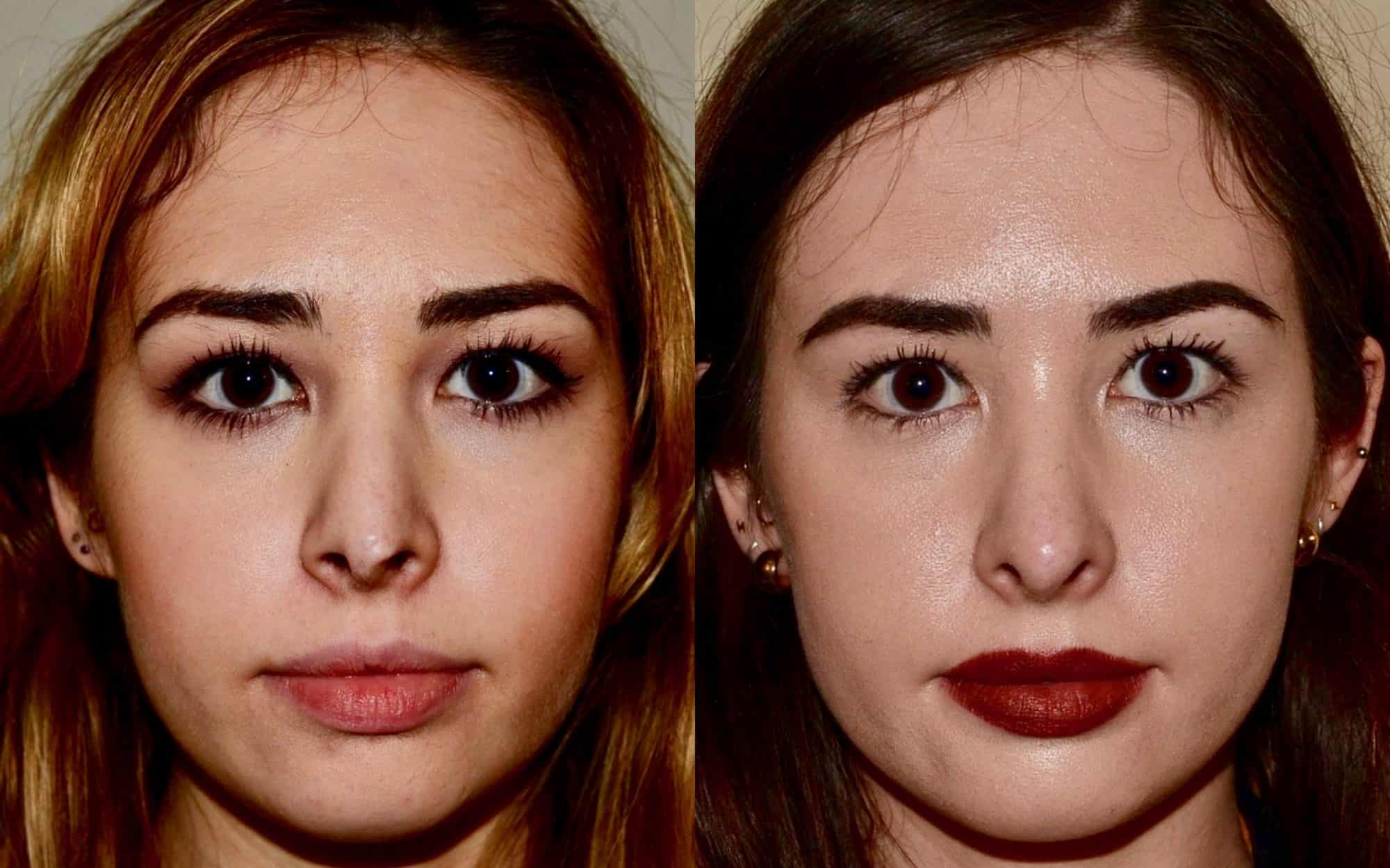 revision rhinoplasty before and after