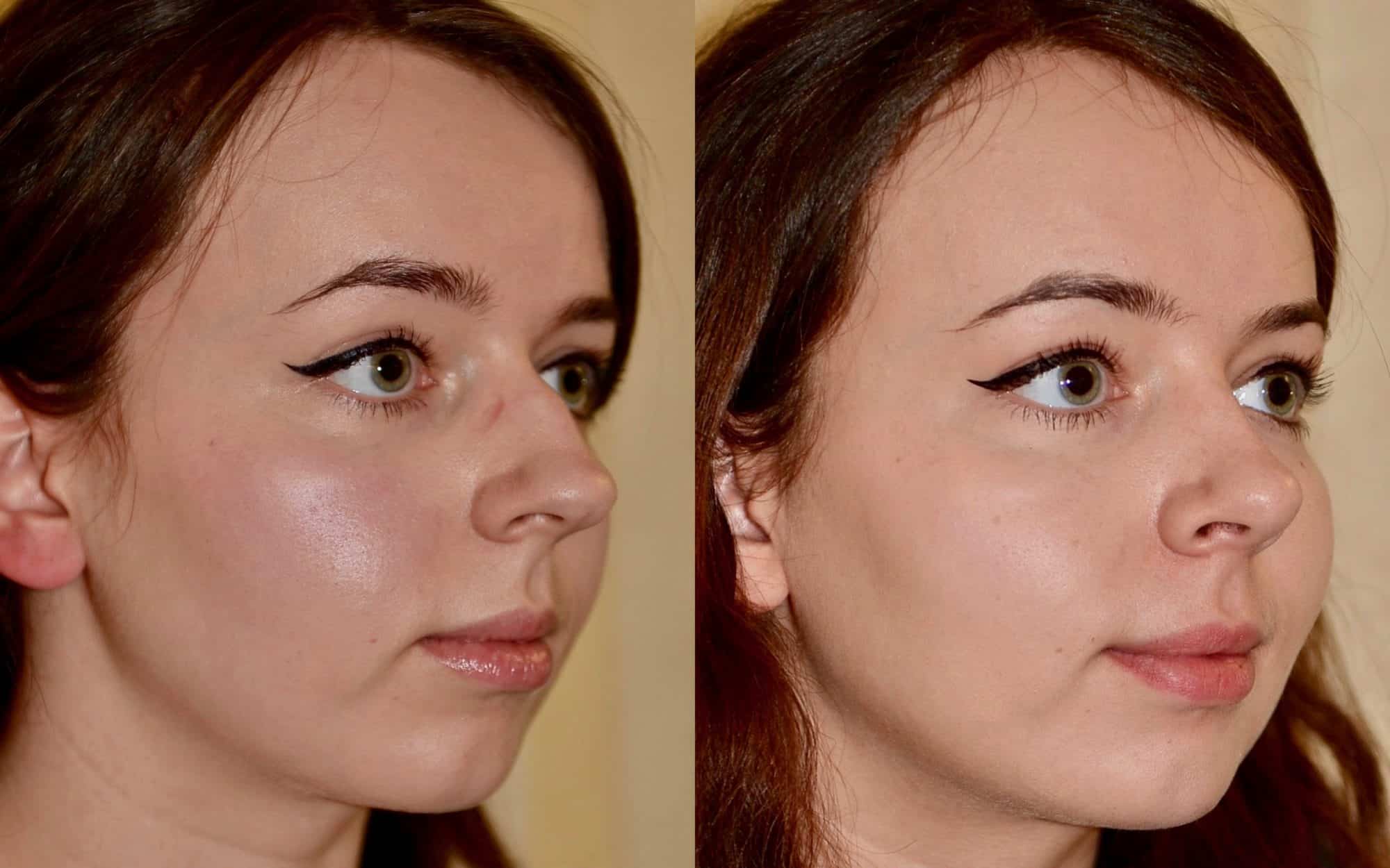 nose job photos