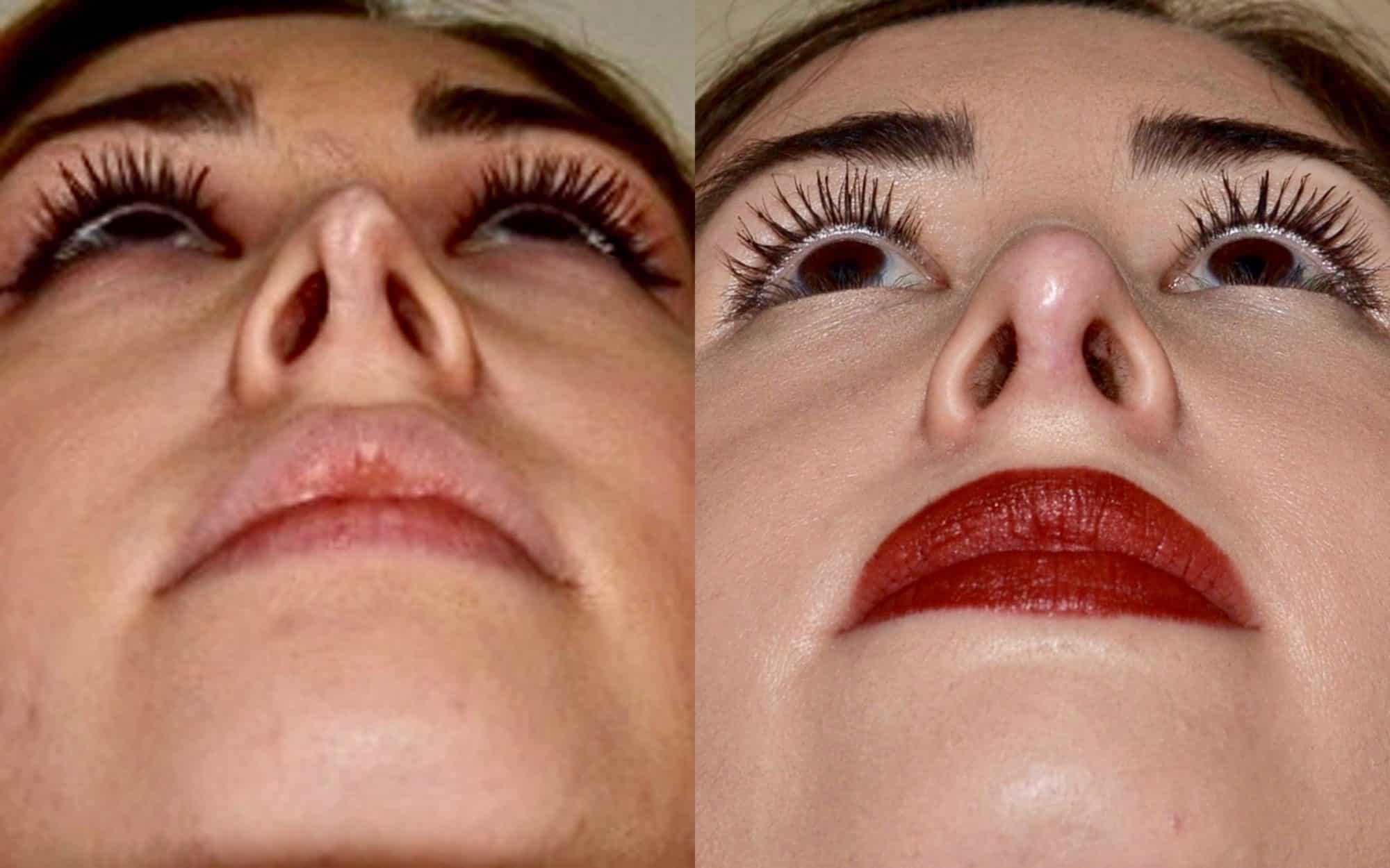 revision rhinoplasty before and after
