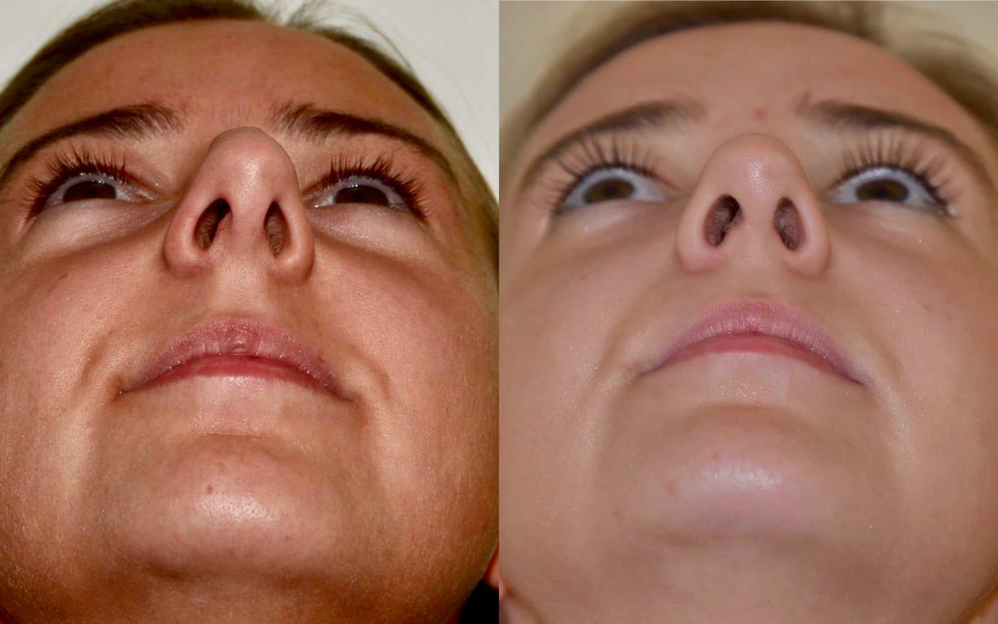 nose job uk before and after