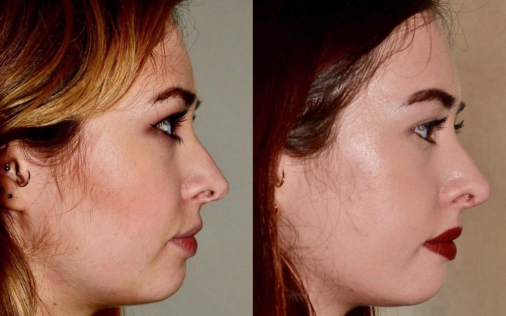 revision rhinoplasty before and after